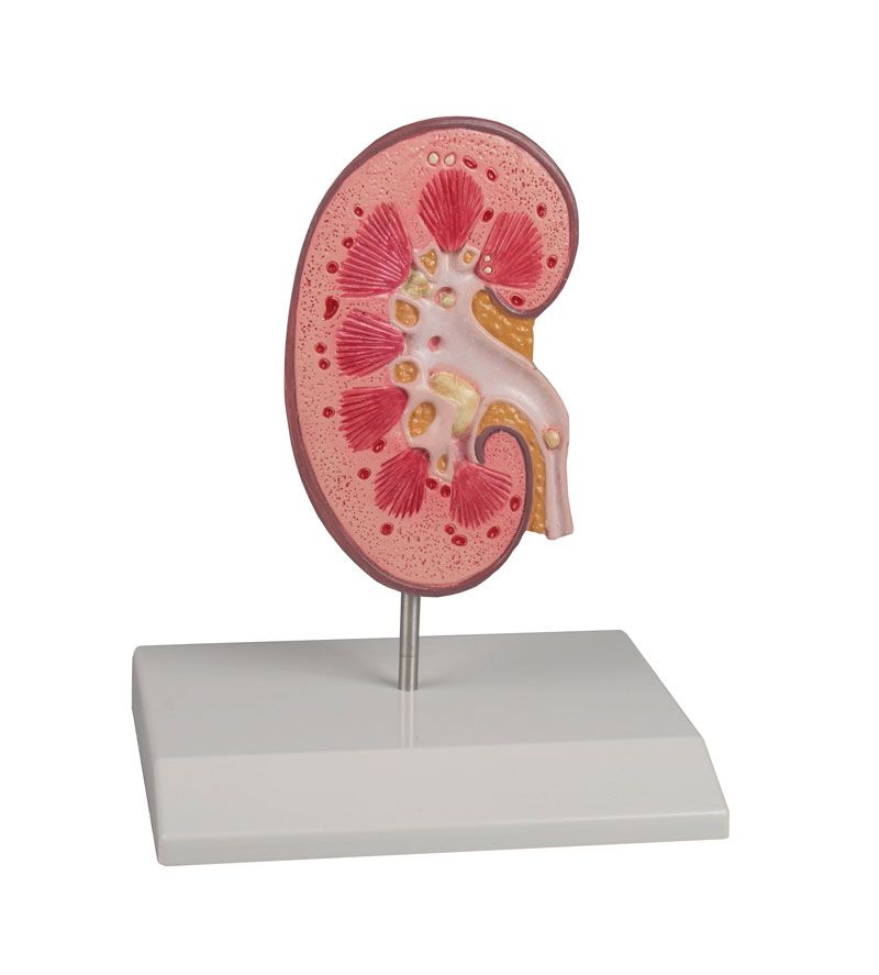 real human kidney stone